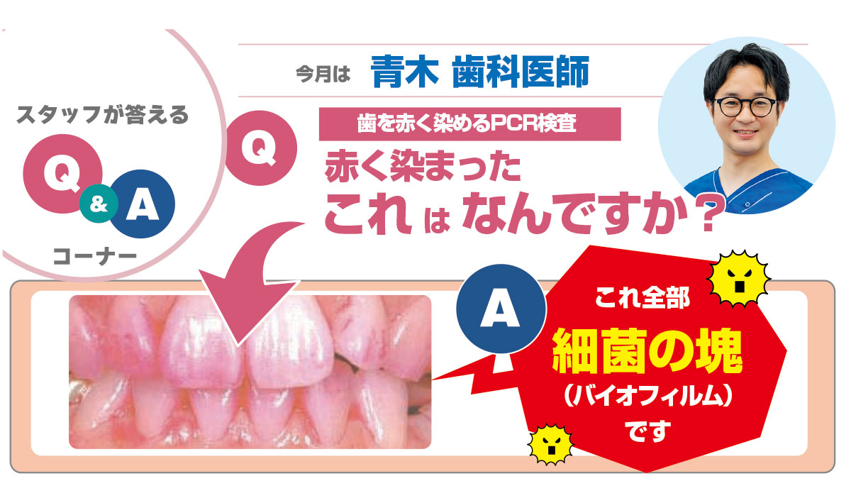 衝撃】あなたの歯が細菌の巣窟に！？バイオフィルムを放置すると
